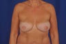 56 Year-Old Woman with Bilateral Breast Reconstruction