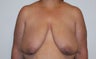 Breast Reconstruction