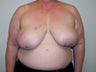 Breast Reconstruction