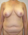 DIEP Flap Breast Reconstruction - Bilateral