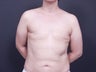37 Year Old Female for Breast Reconstruction