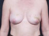 46 Year Old Female for Breast Reconstruction