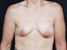 48 Year Old for Breast Reconstruction