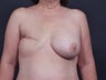 48 Year Old Female for Breast Reconstruction
