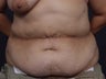Post Tram Flap Abdomen - 46 Year Old Female for Breast Reconstruction