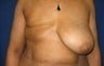 Breast Reconstruction - TRAM flap