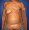 Breast Reconstruction - TRAM flap