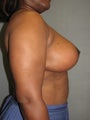 Breast Reduction and Lift