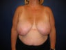 Breast Reduction