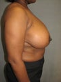 Breast Reduction and Lift