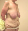 Breast Reduction Surgery and Tummy Tuck