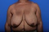 Breast Reduction