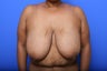 Breast Reduction