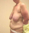 Breast Reduction Surgery and Tummy Tuck