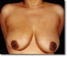 Breast Reduction