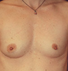 Breast implant removal