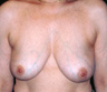 Breast implant removal