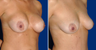 Breast Implant Removal
