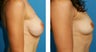 Breast Implant Removal with Internal Lift