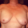 Breast implant removal and breast lift.