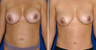 Breast Implant Removal