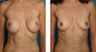 Breast Implant Removal with Internal Lift