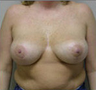 Breast Lift