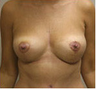 Breast Lift