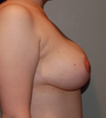 Vertical Breast Lift