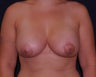breast lift
