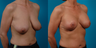 Breast lift and implants