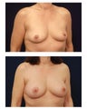 Breast Lift