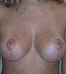 Breast Augmentation/Mastopexy (Lift)