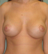 Breast Augmentation / Lift