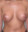 Breast Augmentation / Lift