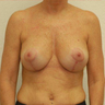 Breast Augmentation / Lift