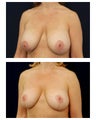 Breast Lift