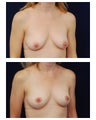 Breast Lift
