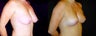 Breast Lift/Mastopexy