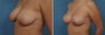 Breast Lift/Mastopexy