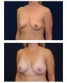 Breast Augmentation with Lift