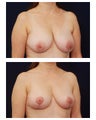 Breast Lift