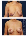 Breast Augmentation with Lift