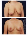 Breast Augmentation with Lift