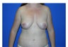 Breast Lift