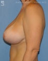 Breast Lift & Augmentation
