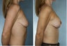 Breast Lift