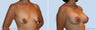 Breast Augmentation