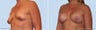 breast lift