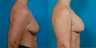 Breast lift and implants